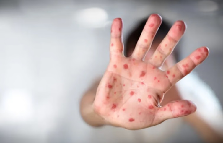 Alertan por los argentinos que regresan del Mundial: advierten una enfermedad muy contagiosa